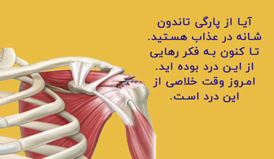 پارگی تاندون شانه 9
